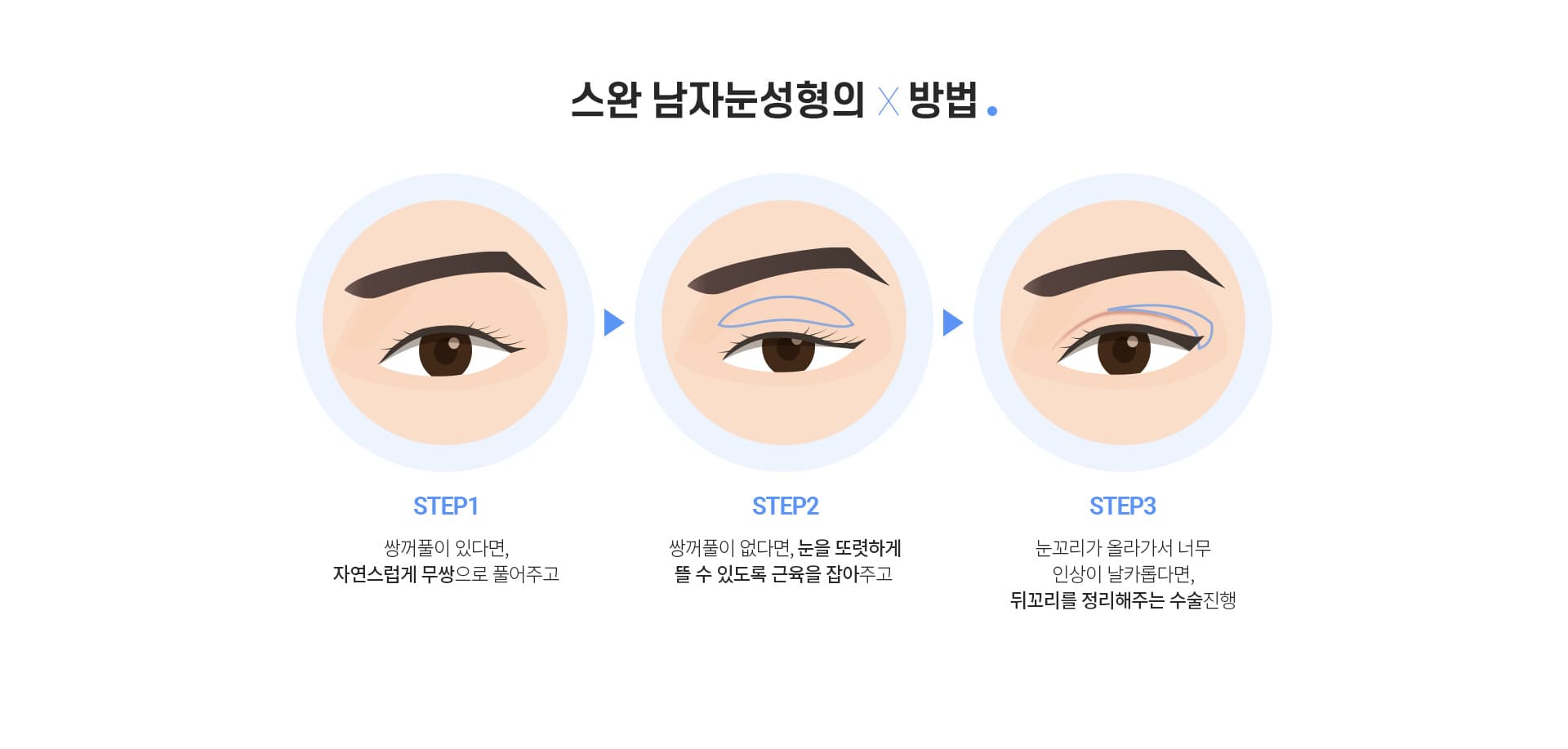 스완 남자눈성형의×방법