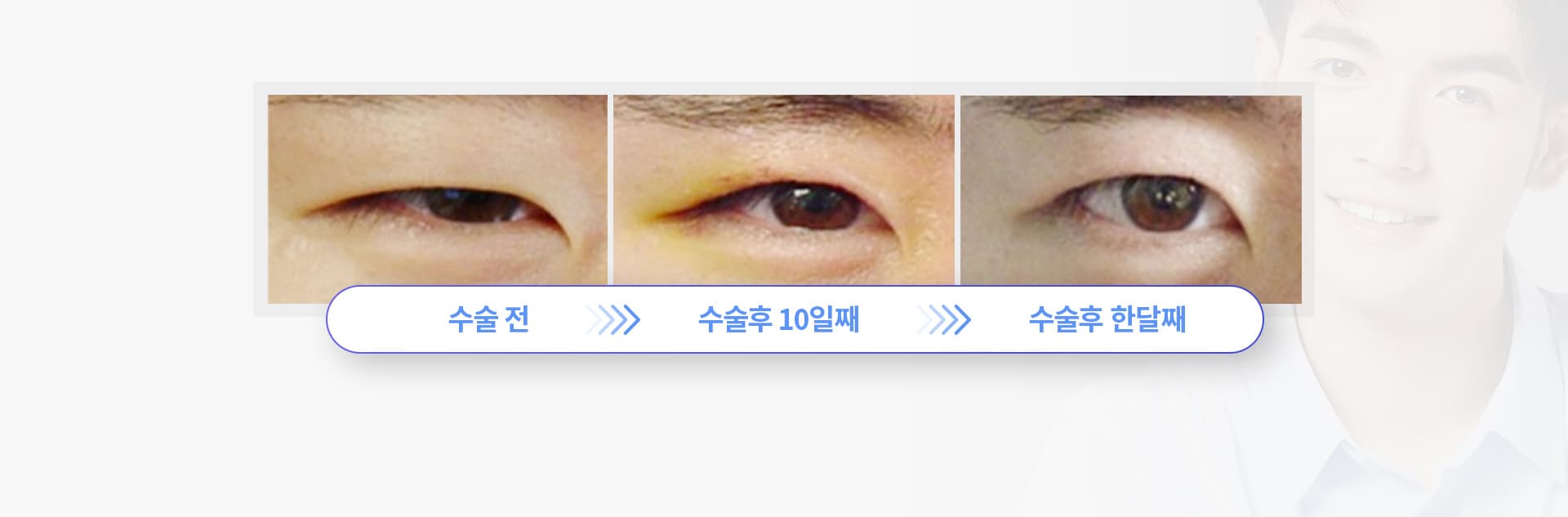 수술전 수술후10일째 수술후 한달째