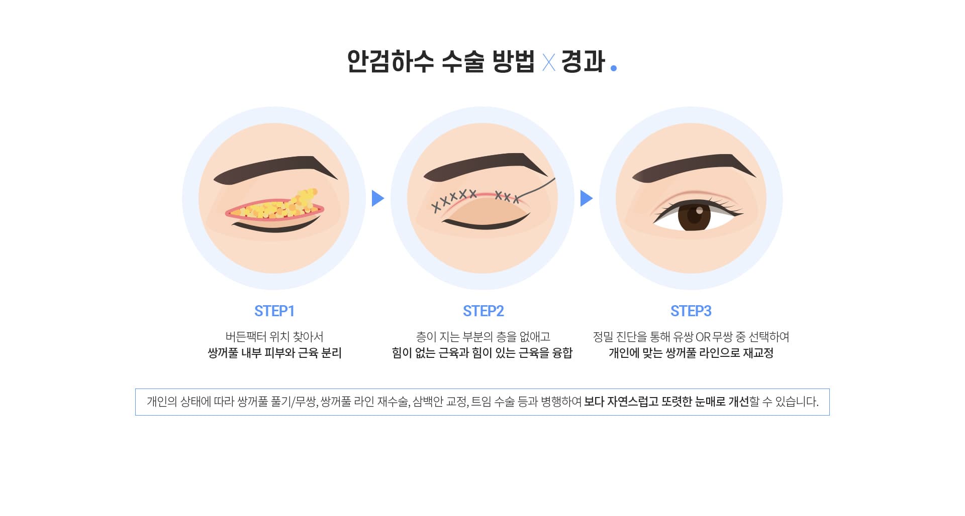 안검하수수술 방법×경과