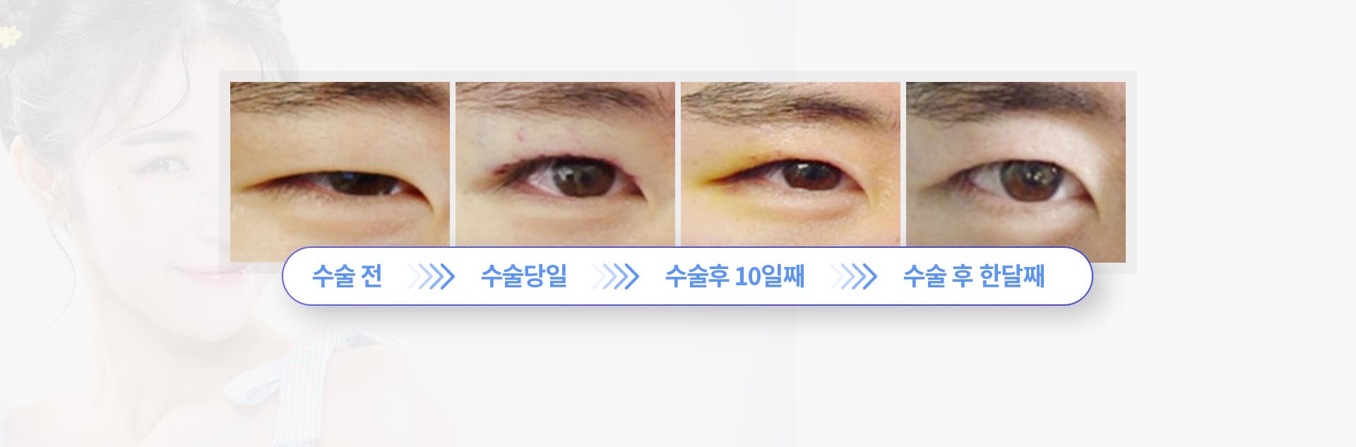수술전 수술당일 수술후10일째 수술후 한달째