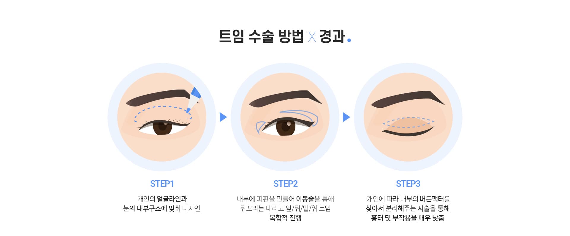 트임 수술 방법×경과