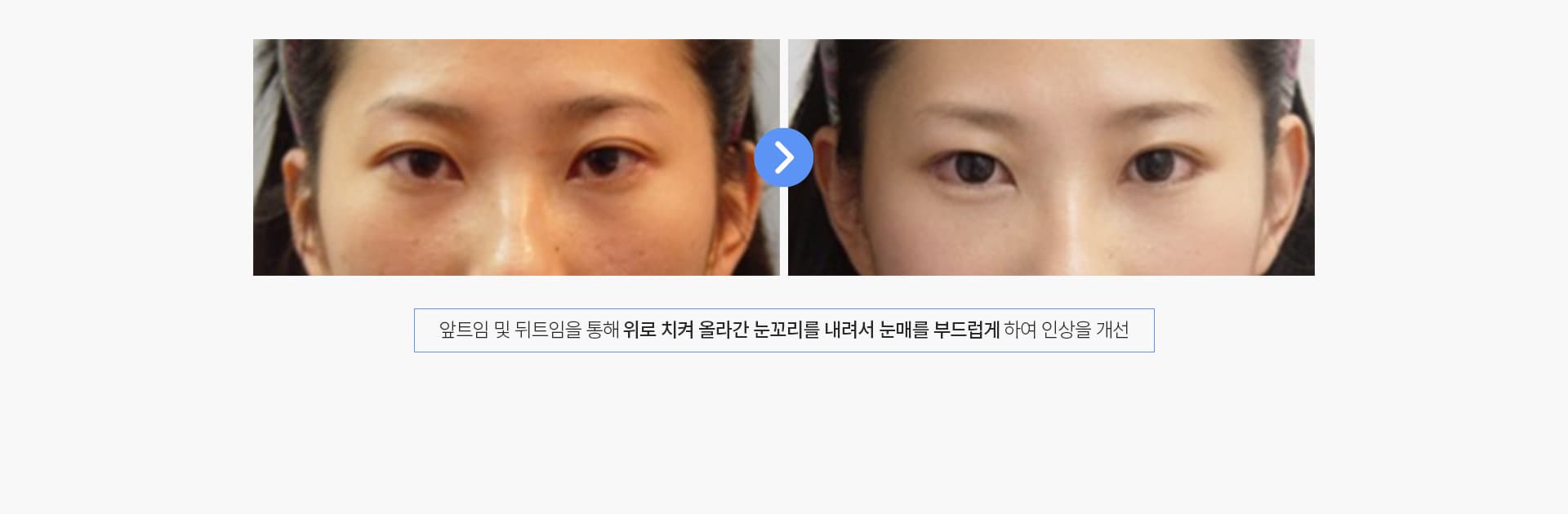 앞트임 및 뒤트임을 통해 위로 치켜 올라간 눈꼬리를 내려서 눈매를 부드럽게 하여 인상을 개선