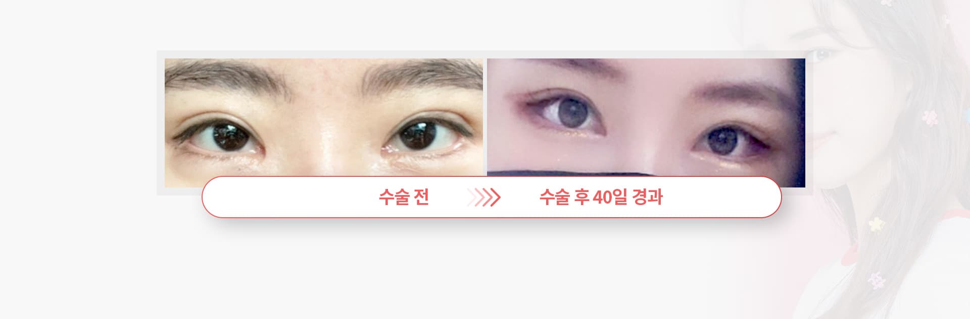 수술전 수술 후 40일 경과