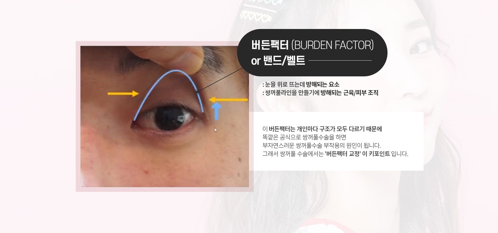 버든팩터(BURDEN FACTOR)