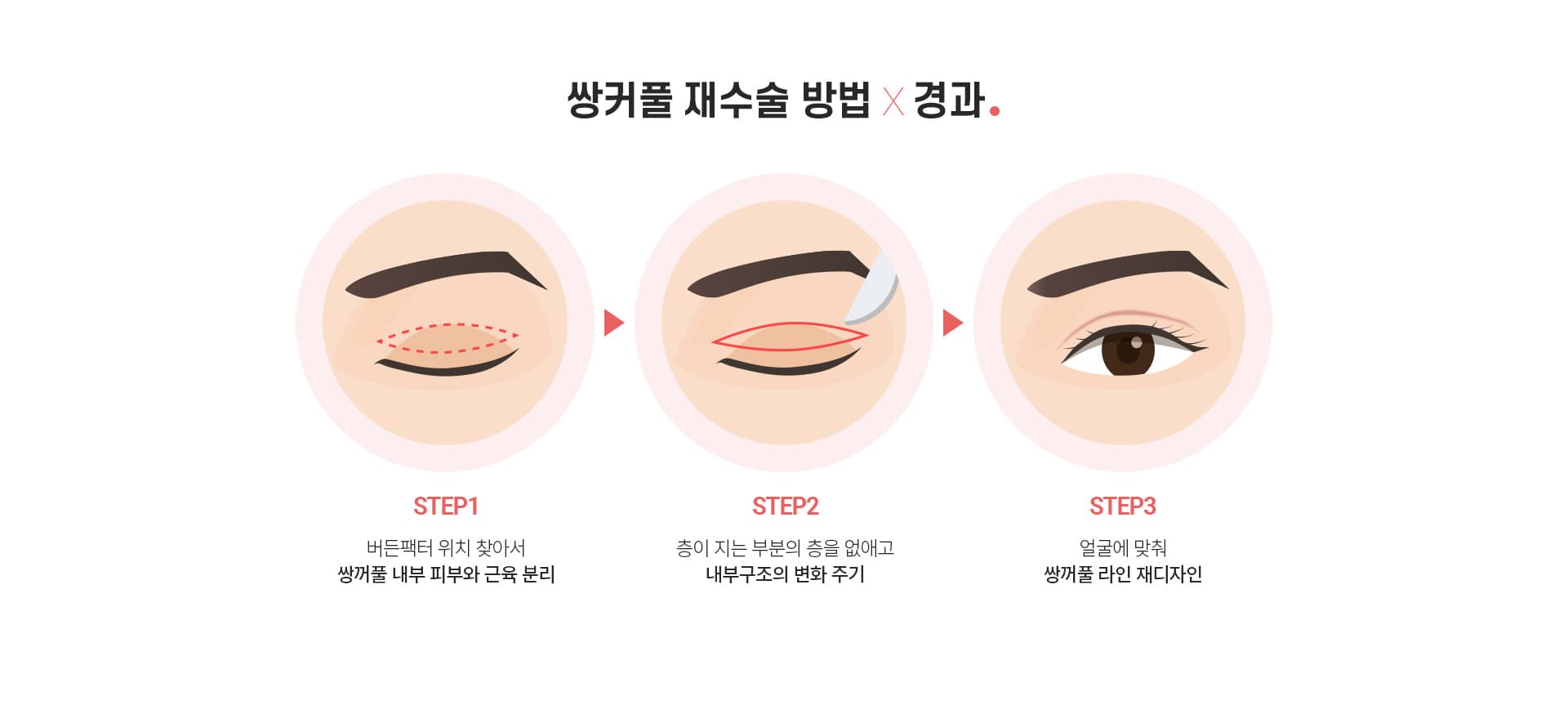 쌍커풀 재수술 방법×경과.
