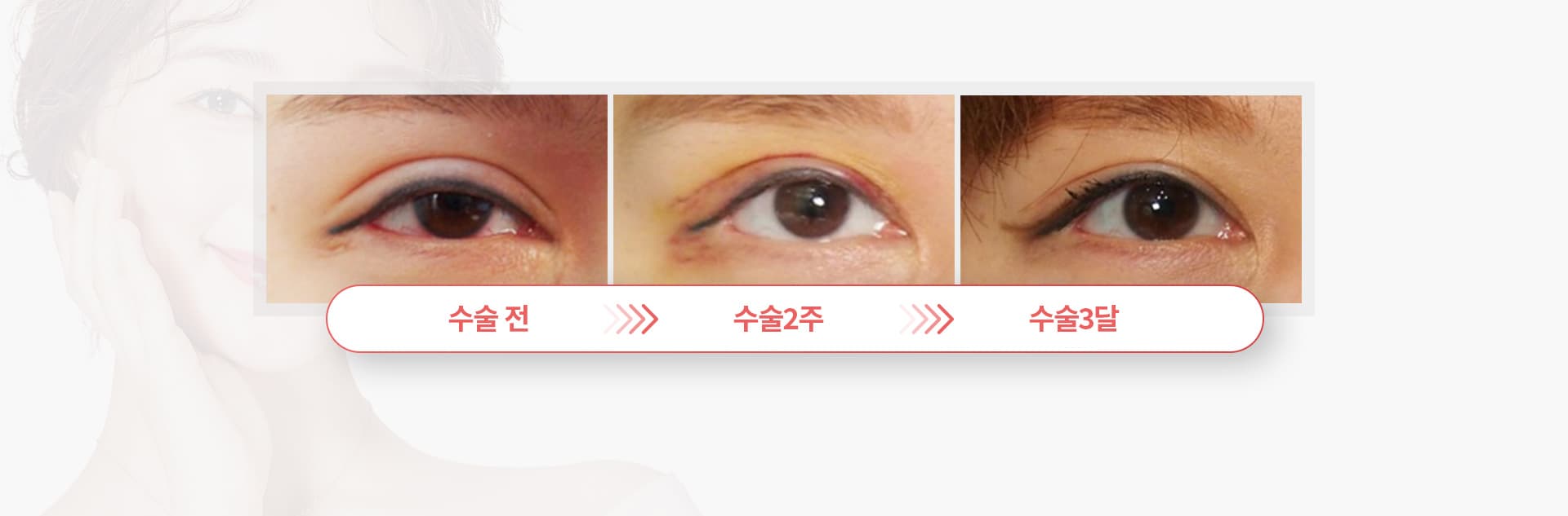수술전 수술2주 수술3달