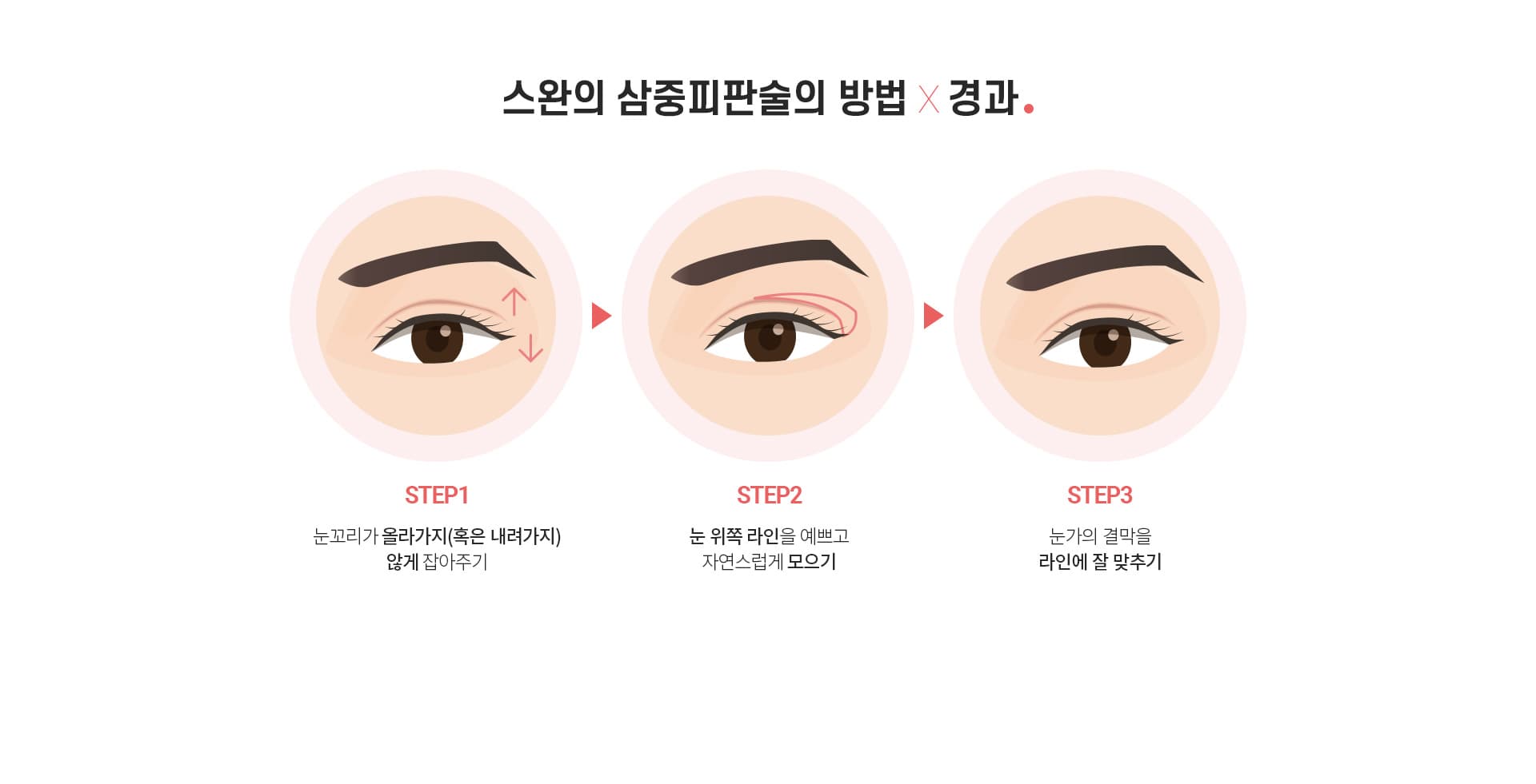 스완의 삼중피판술의 방법×경과.