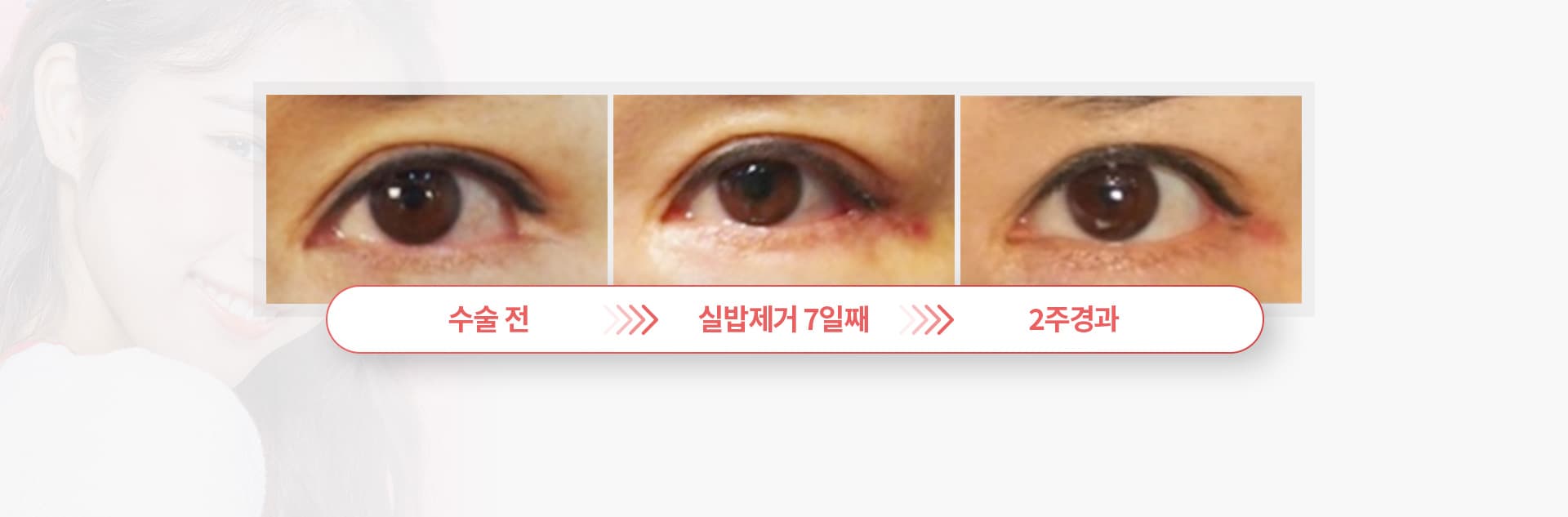 수술전 실밥제거7일째 2주경과