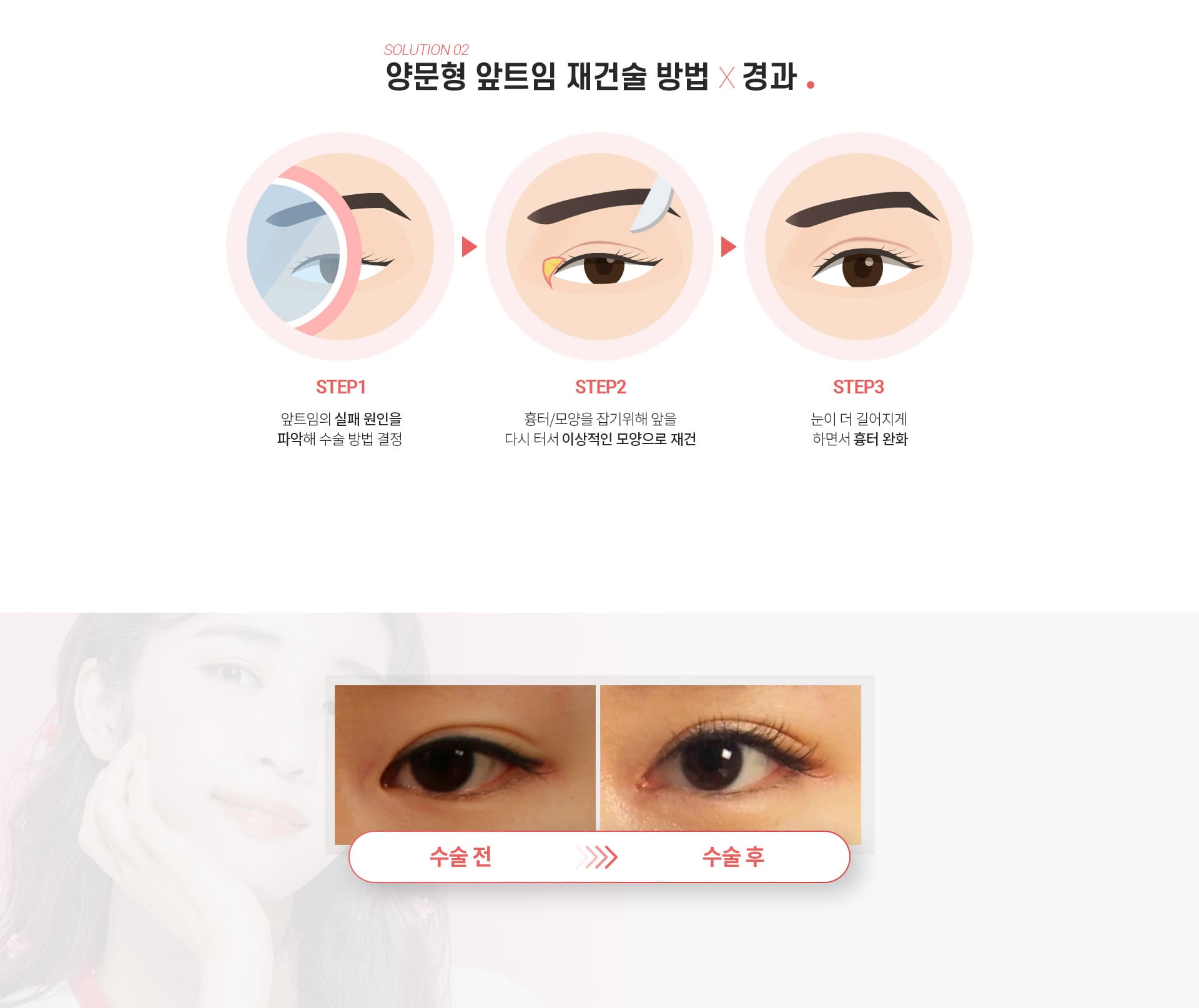 양문형 앞트임재건술방법×경과 SOLUTION 02 ’