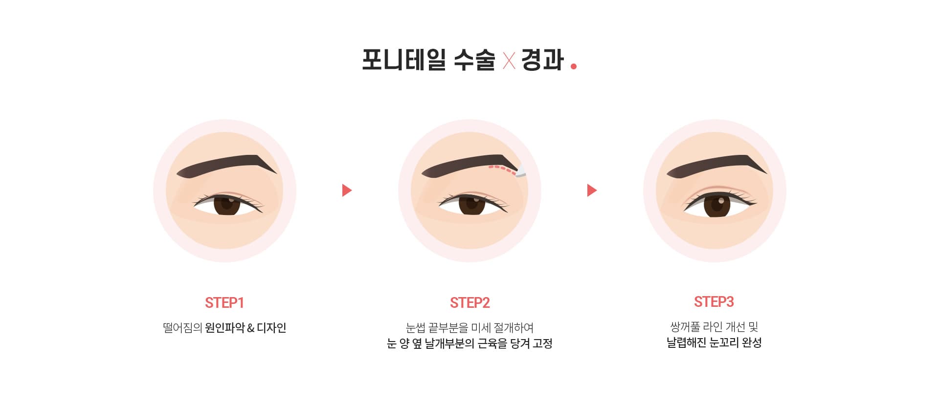 포니테일 수술×경과.