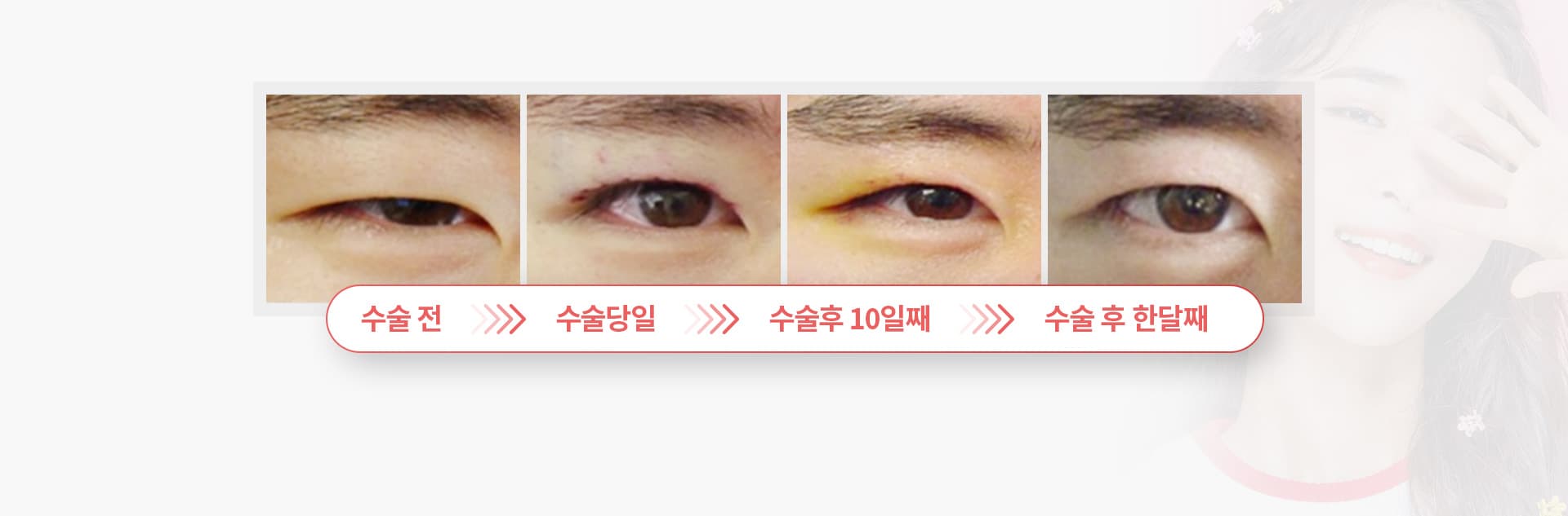 수술전 수술당일 수술후 10일째 수술 후 한달째
