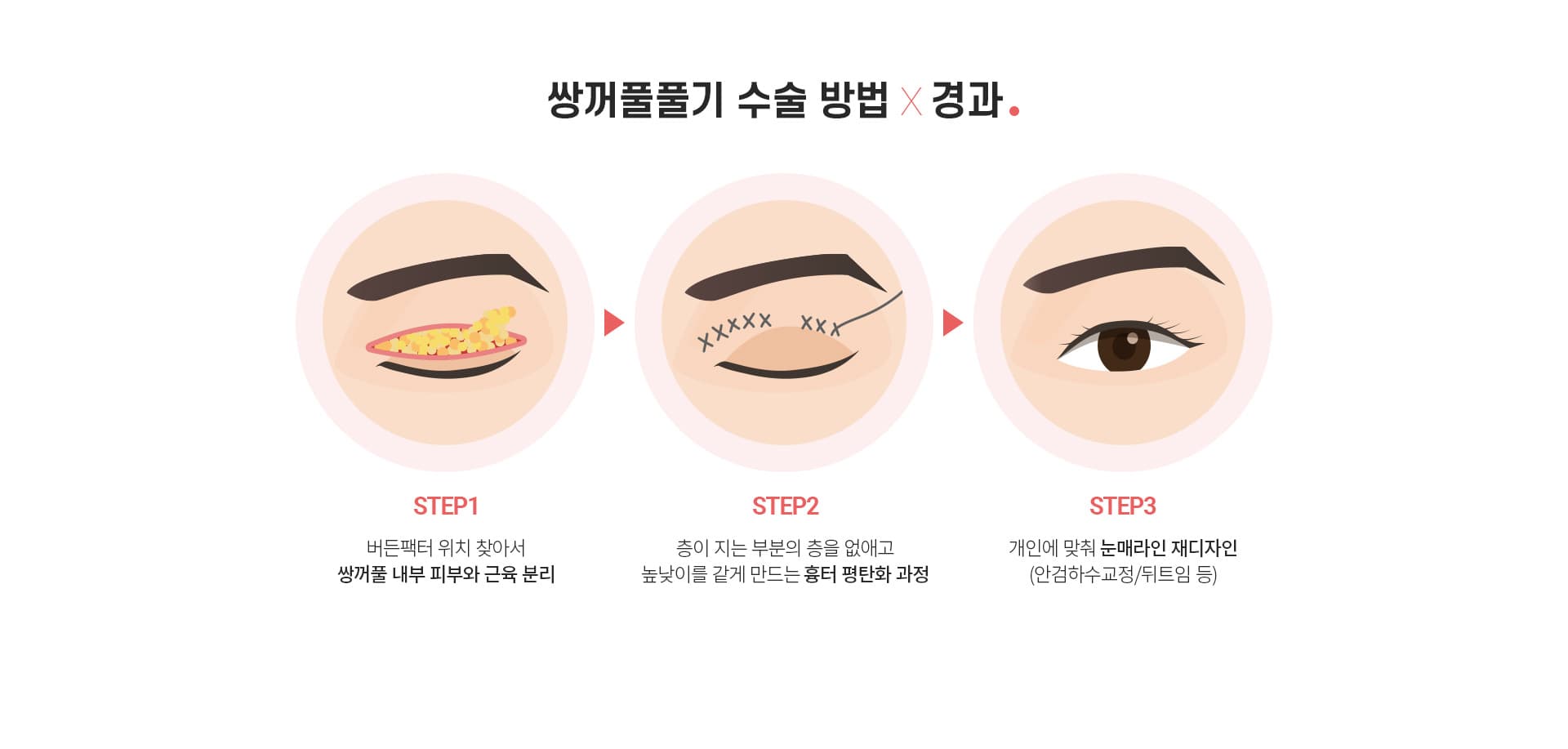 쌍꺼풀풀기 수술 방법×경과.