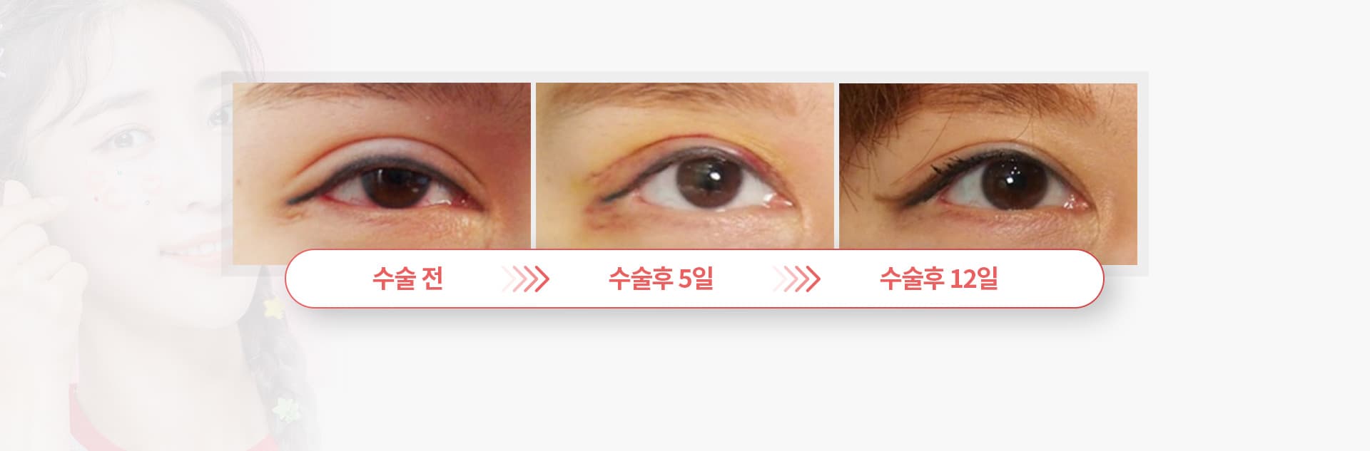 수술전 수술후5일 수술후12일