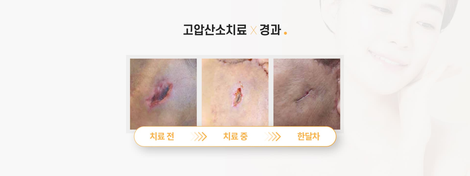 고압산소치료×경과