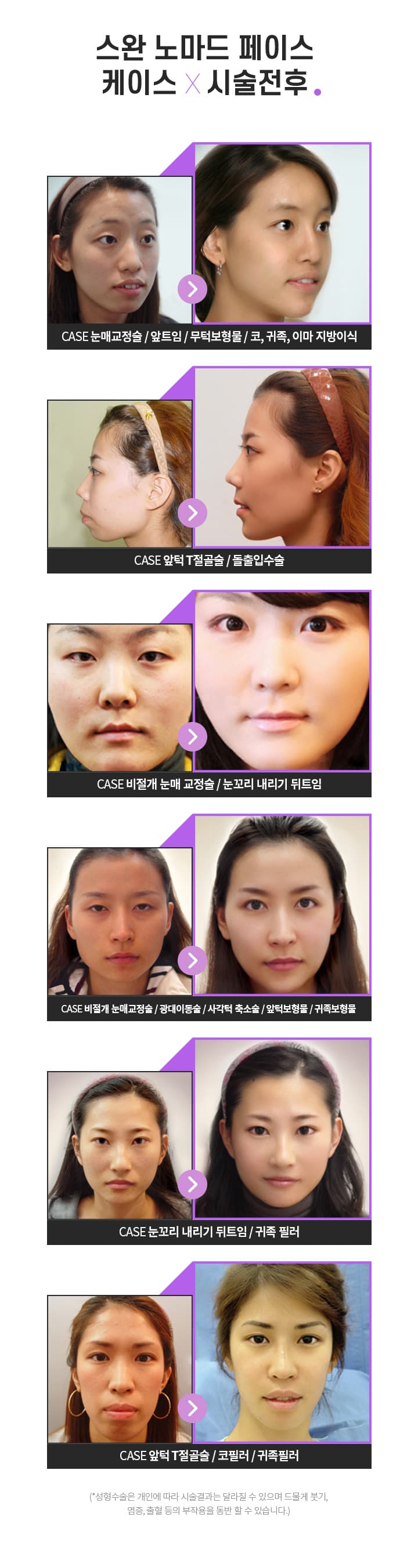스완 노마드 페이스 케이스 ×시술전후