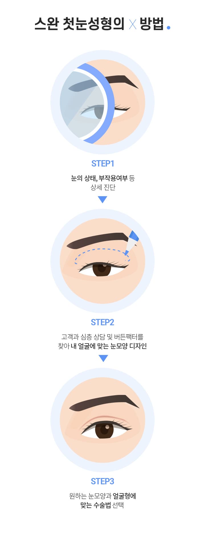 스완 첫눈성형의×방법