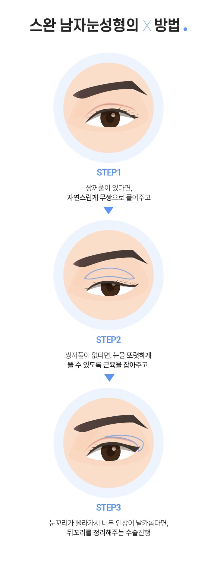 스완 남자눈성형의×방법