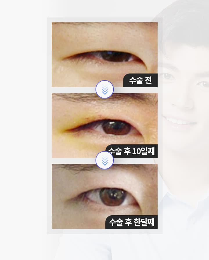 수술전 수술후10일째 수술후 한달째