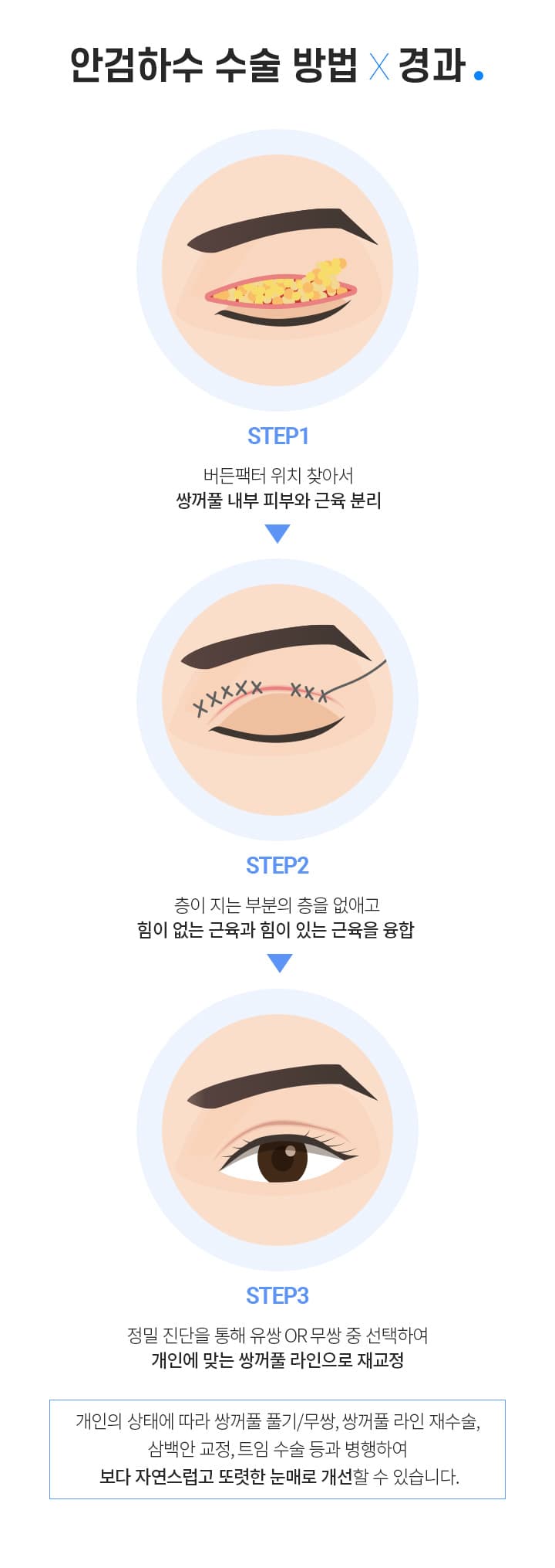안검하수수술 방법×경과