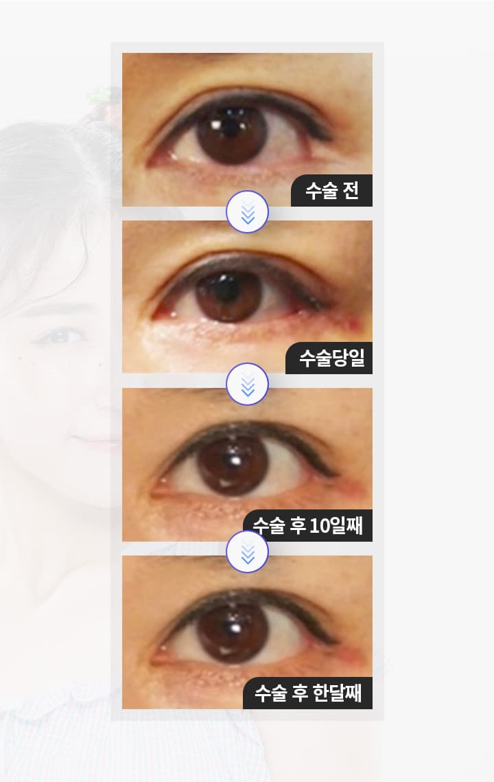 수술전 수술당일 수술후10일째 수술후 한달째