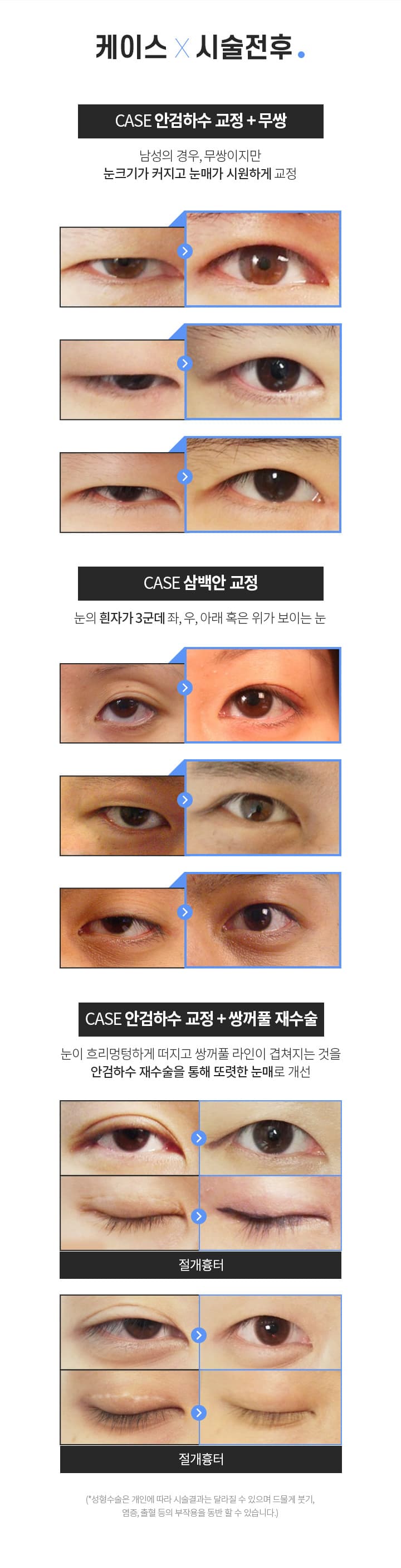 케이스 ×시술전후