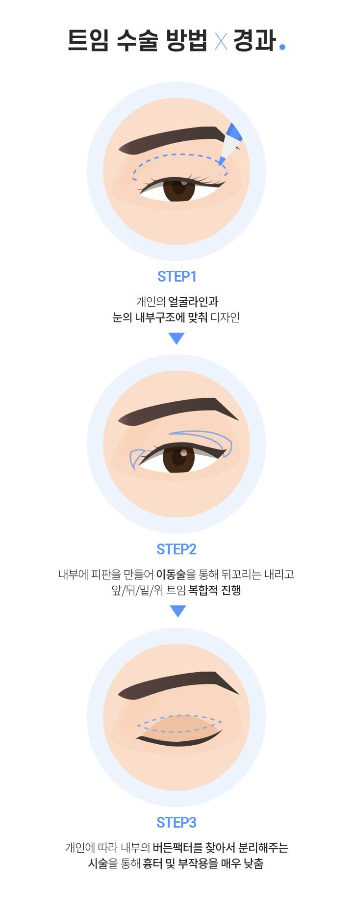 트임 수술 방법×경과