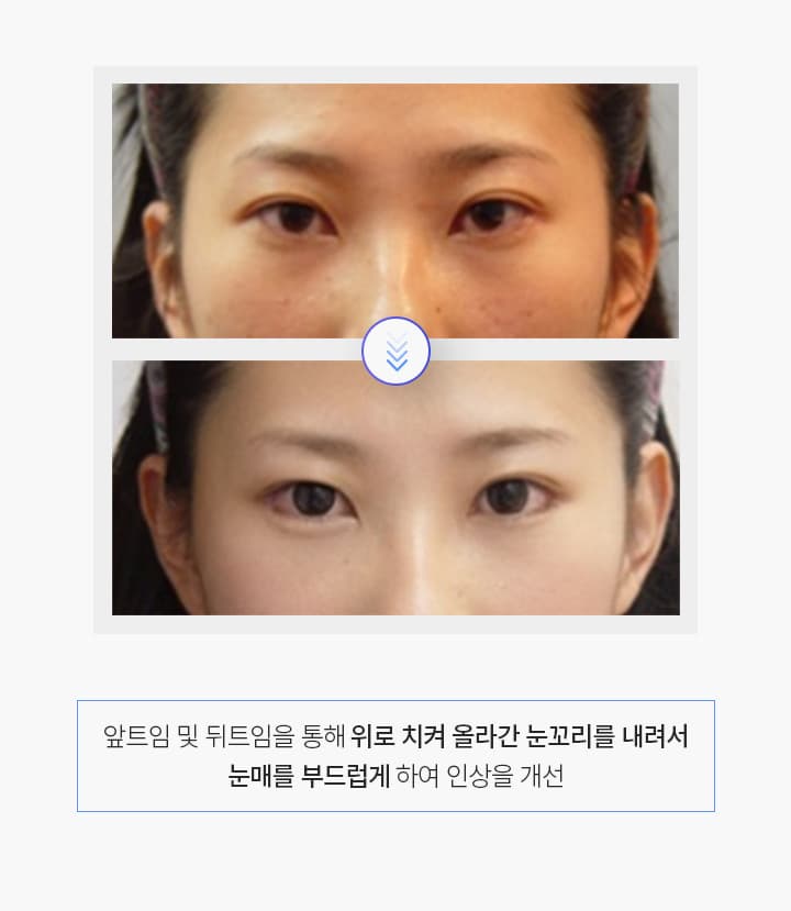 앞트임 및 뒤트임을 통해 위로 치켜 올라간 눈꼬리를 내려서 눈매를 부드럽게 하여 인상을 개선