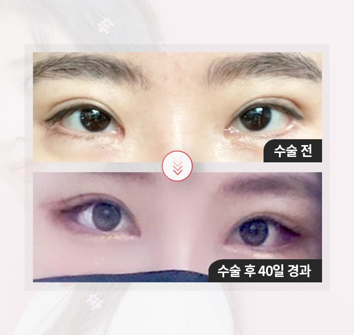 수술전 수술 후 40일 경과
