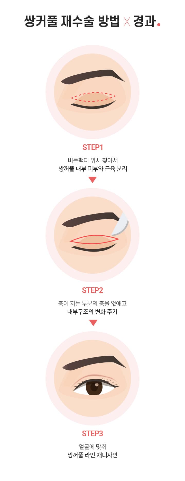 쌍커풀 재수술 방법×경과.