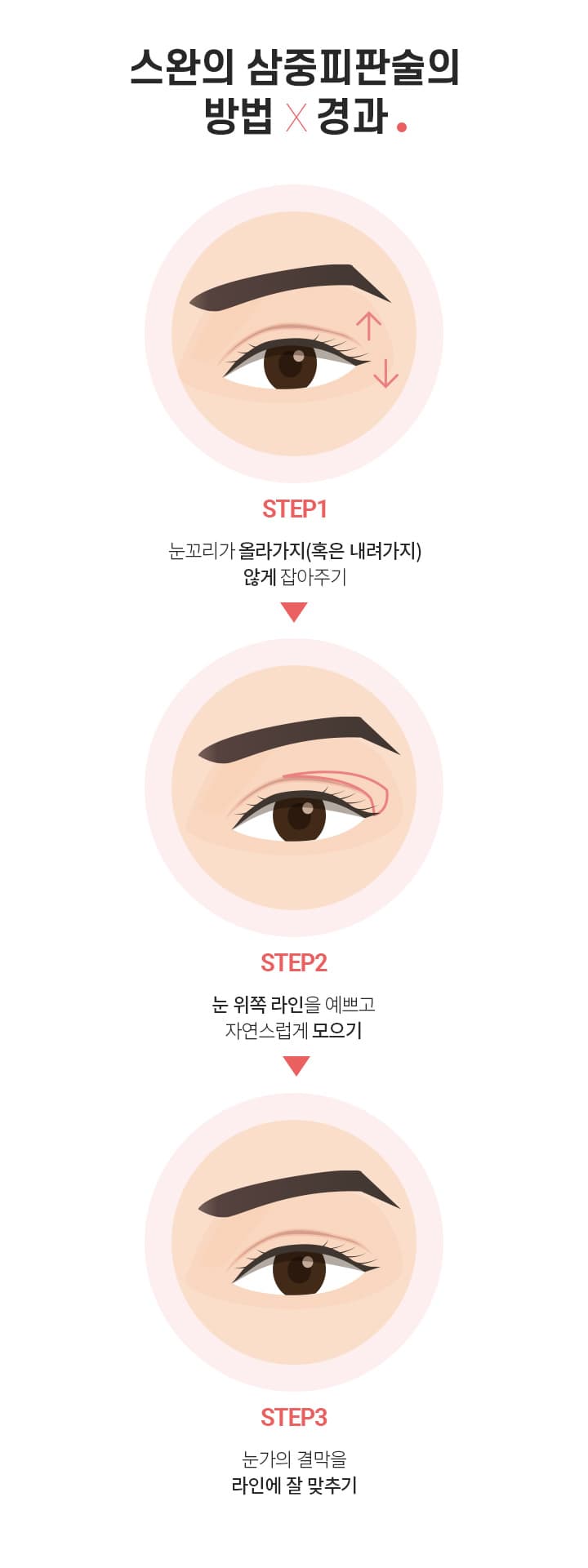 스완의 삼중피판술의 방법×경과.