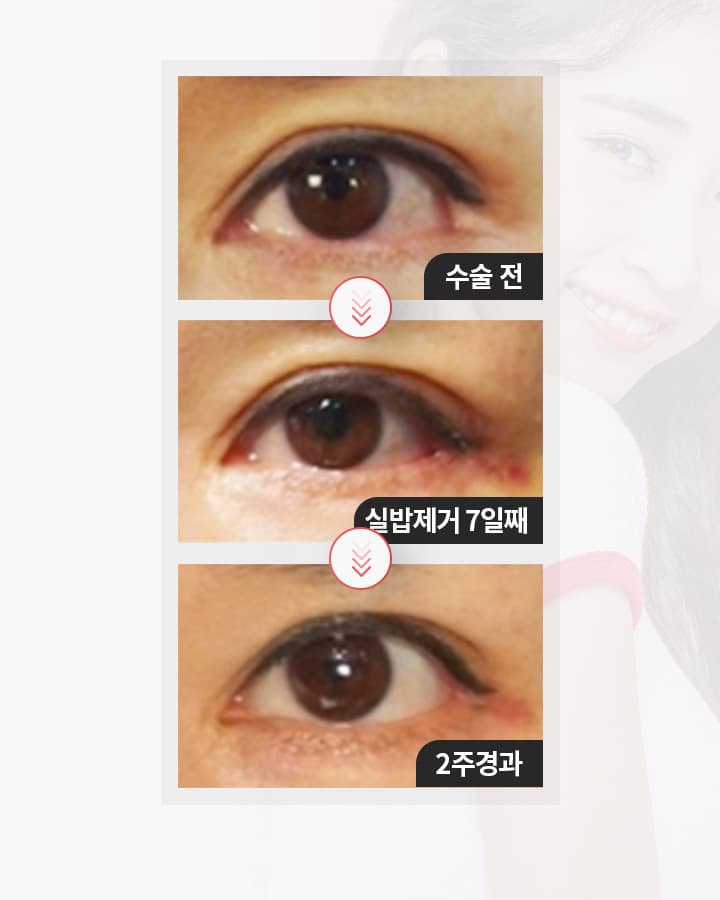 수술전 실밥제거7일째 2주경과
