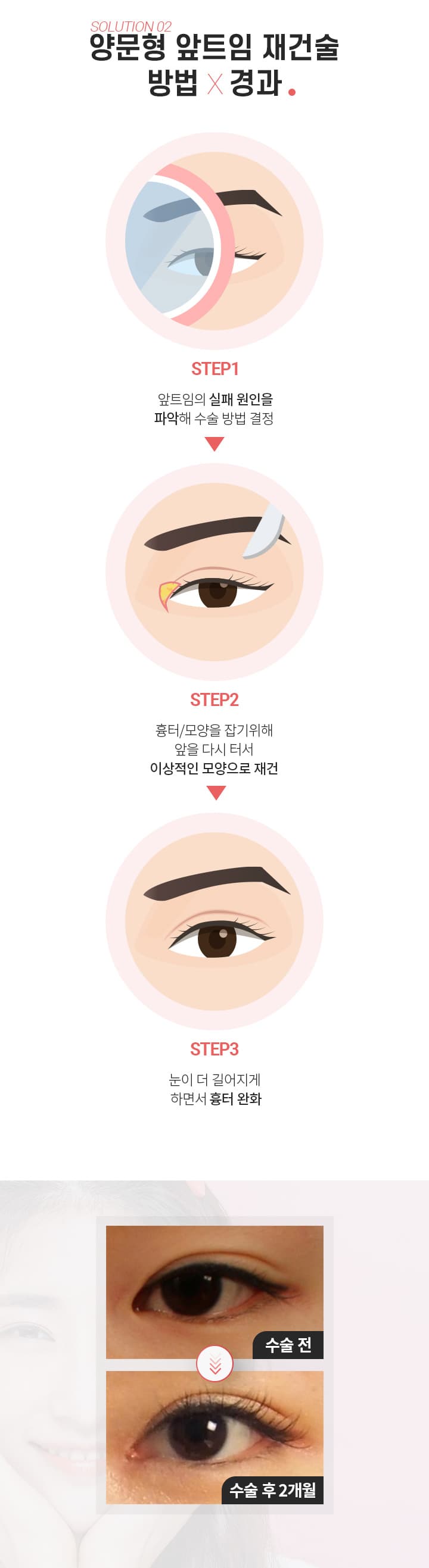 양문형 앞트임재건술방법×경과 SOLUTION 02 ’