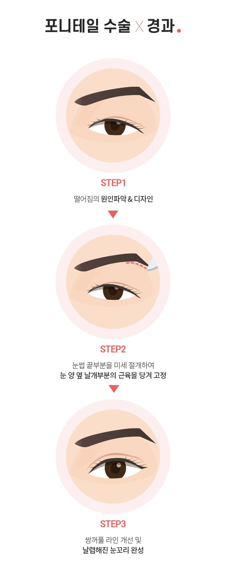 포니테일 수술×경과.
