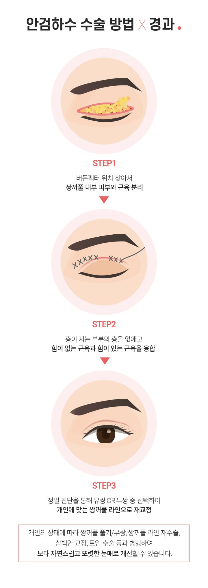 안검하수수술 방법×경과