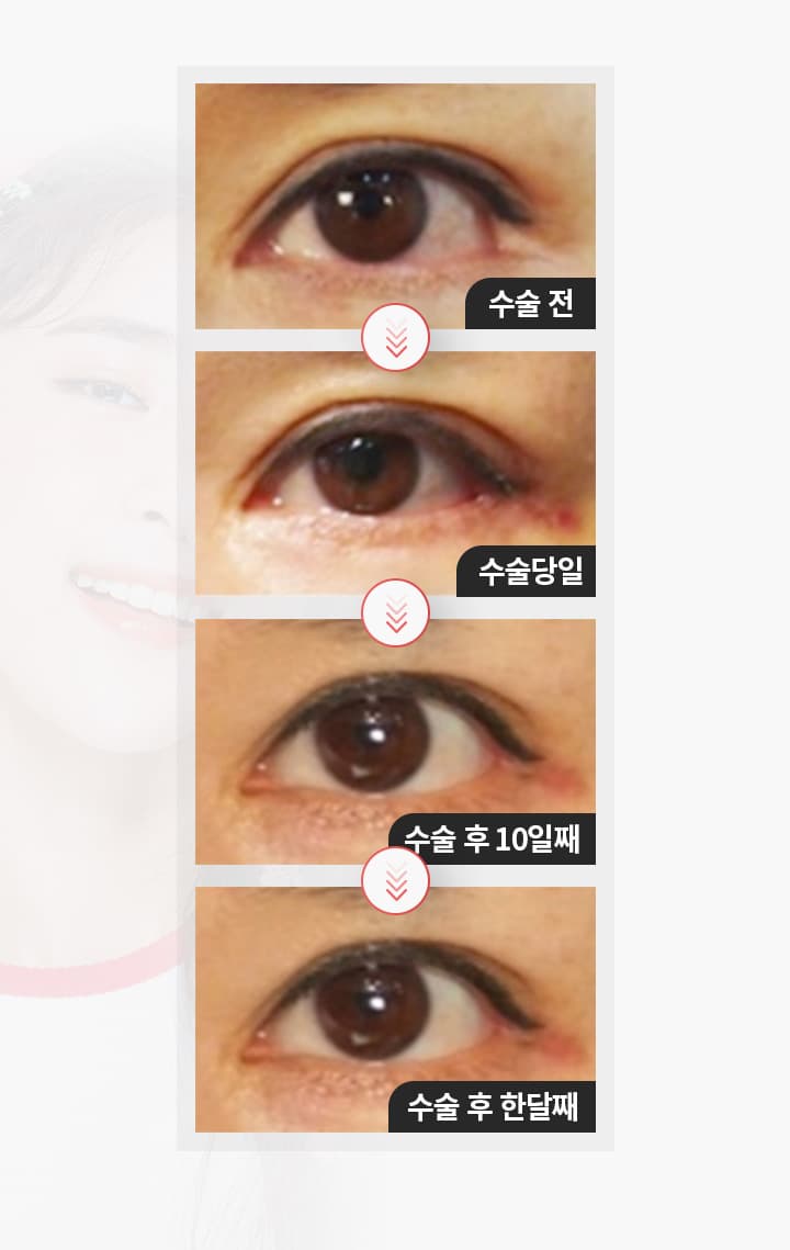 수술전 수술당일 수술후 10일째 수술 후 한달째