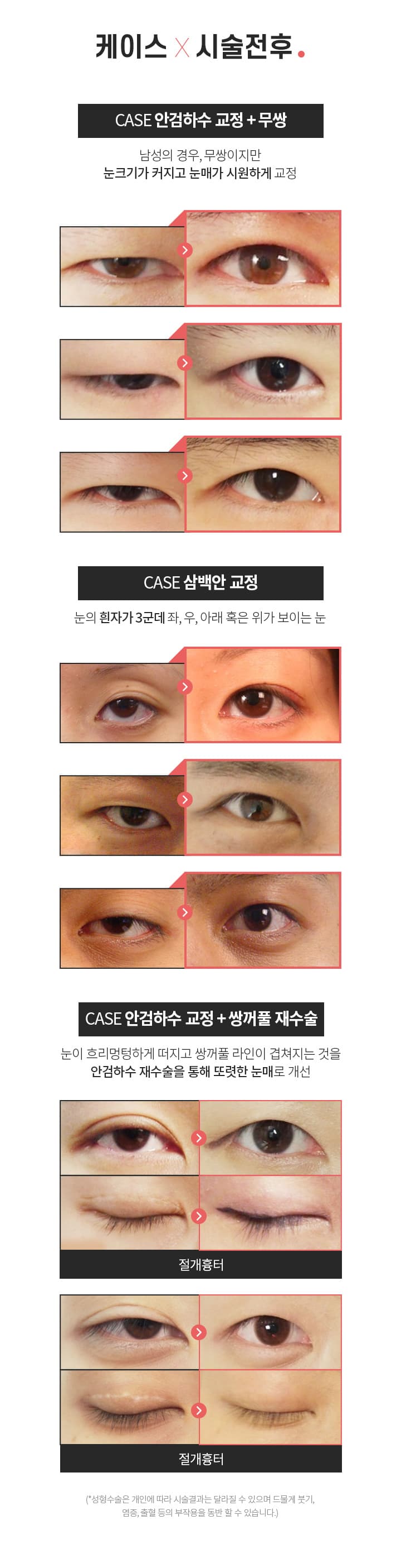 케이스 ×시술전후