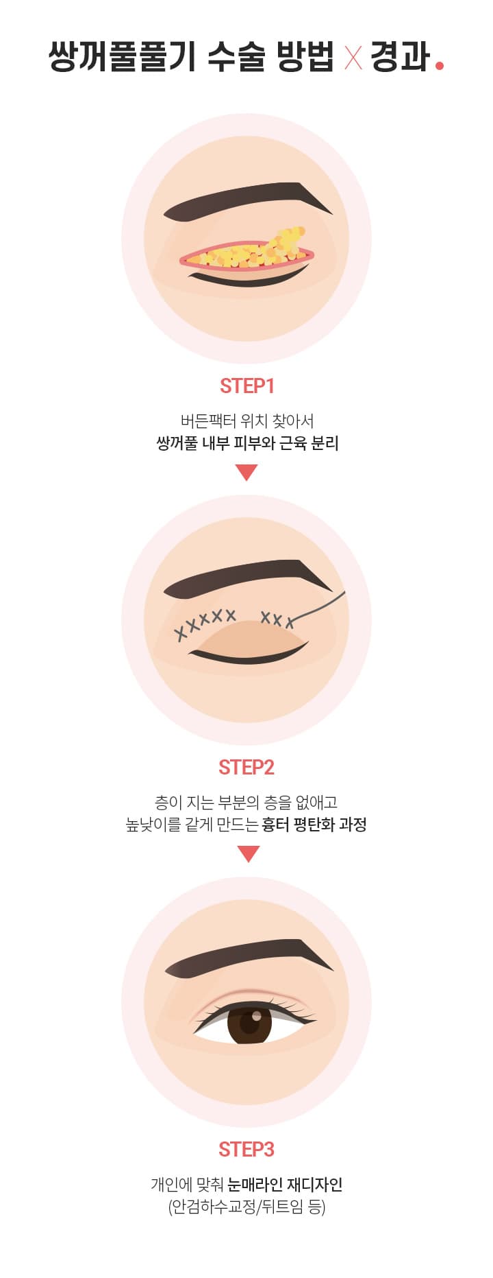 쌍꺼풀풀기 수술 방법×경과.