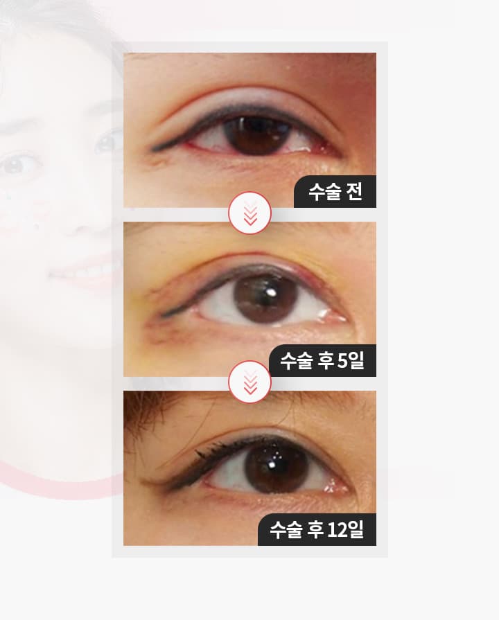 수술전 수술후5일 수술후12일