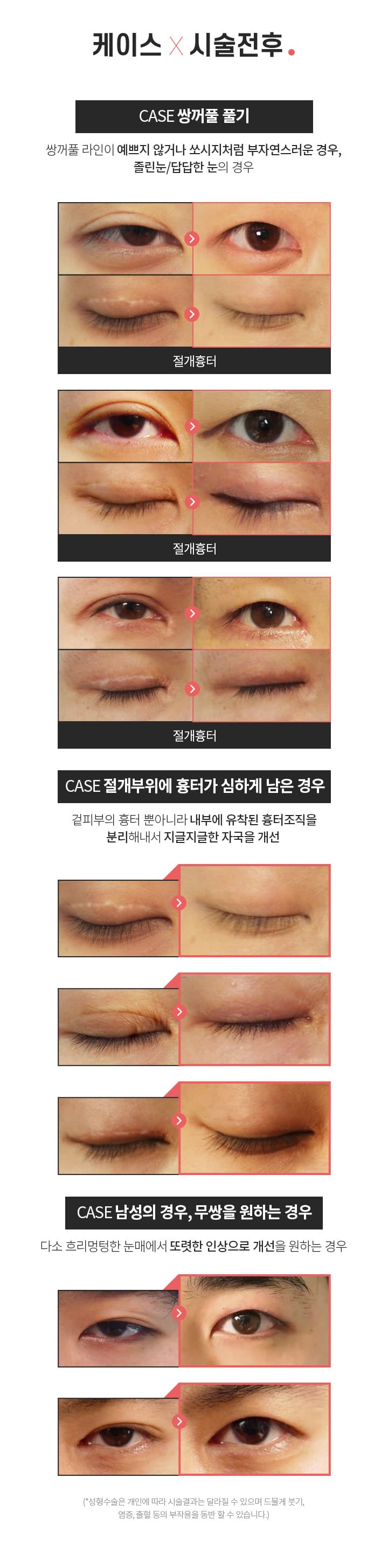 케이스×시술전후