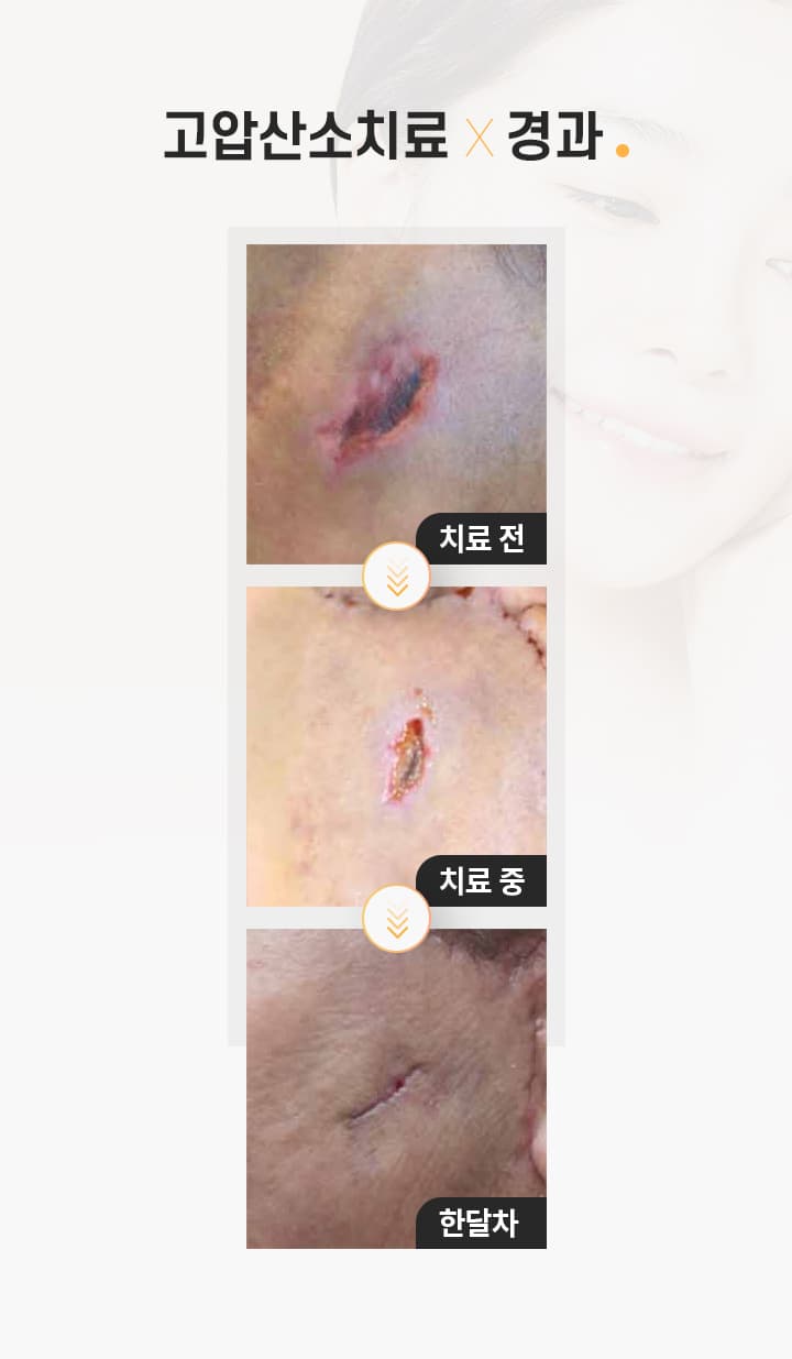 고압산소치료×경과